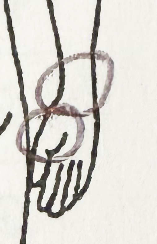 Initial pain drawing: radial thumb/thenar paresthesia