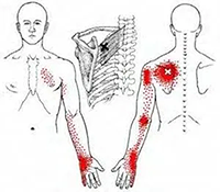 Levator scapulae referral pattern thumbnail